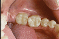 Dental composite filling
