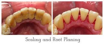 Dental scaling treatment